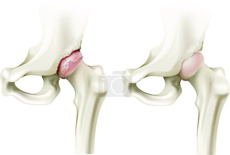 Téléchargez les illustrations : Arthrite de la hanche, illustration vectorielle graphique - en licence libre de droit