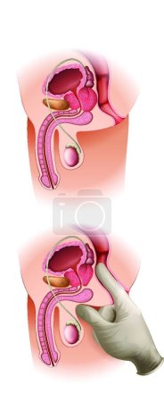 Téléchargez les illustrations : Illustration vectorielle du cancer de la prostate - en licence libre de droit
