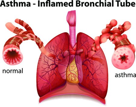 Ilustración de Asma bronquial, ilustración simple del icono de la tela - Imagen libre de derechos