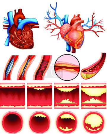 Ilustración de Corazón colesterol vector ilustración - Imagen libre de derechos