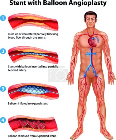 Ilustración de Ilustración del vector del procedimiento de angioplastia del stent - Imagen libre de derechos
