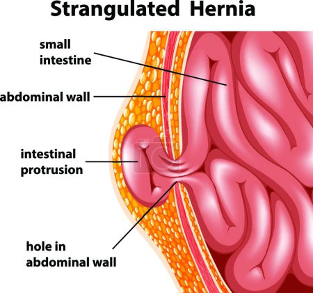 Illustration for Strangulated Hernia   vector illustration - Royalty Free Image