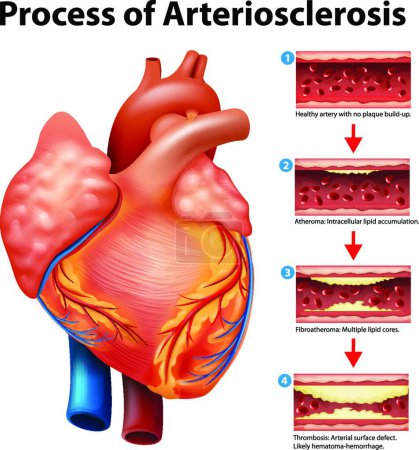 Ilustración de Proceso de Arteriosclerosis, ilustración vectorial diseño simple - Imagen libre de derechos