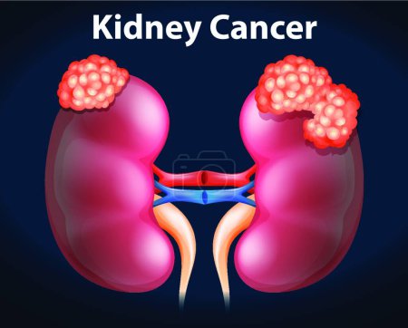 Photo for "Diagram showing kidney cancer" - Royalty Free Image