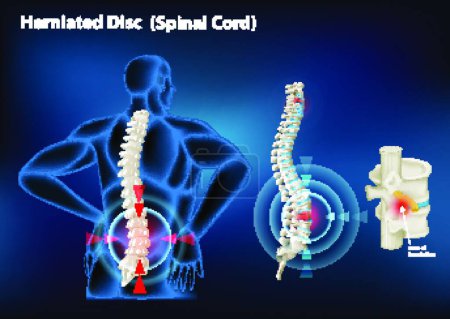 Illustration for "Diagram showing herniated disc in human" - Royalty Free Image