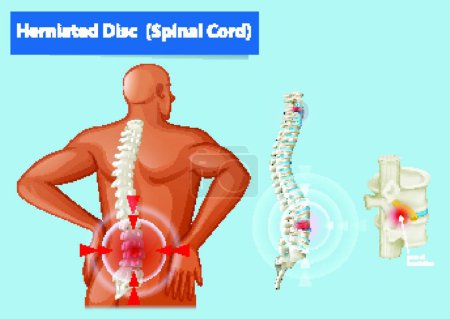 Illustration for "Diagram showing herniated disc in human" - Royalty Free Image