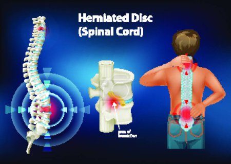 Illustration for Diagram showing herniated disc - Royalty Free Image