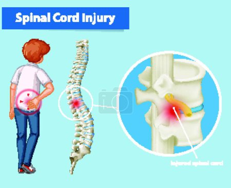 Illustration for Diagram showing spinal cord injury - Royalty Free Image