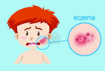 Ilustración de Niño enfermo con eczema vector ilustración - Imagen libre de derechos