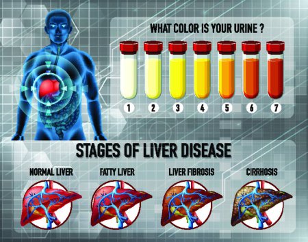 Illustration for Stages of liver disease - Royalty Free Image