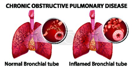 Ilustración de Enfermedad pulmonar obstructiva crónica - Imagen libre de derechos