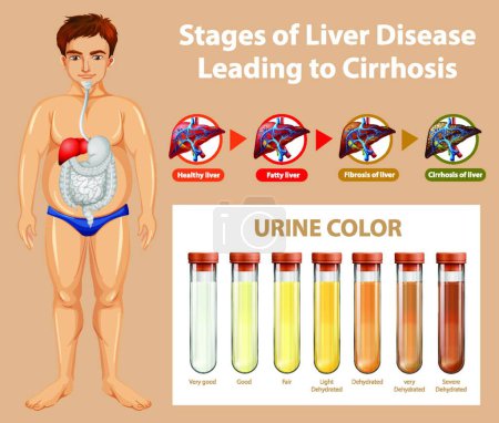 Illustration for Stages of liver disease leading to Cirrhosis - Royalty Free Image