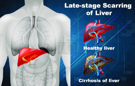Illustration for Late-stage scarring of liver, vector illustration simple design - Royalty Free Image