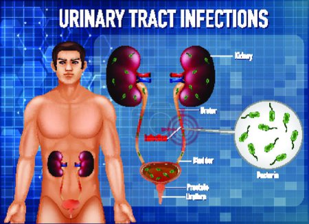 Illustration for Information poster of urinary tract infections, vector illustration simple design - Royalty Free Image
