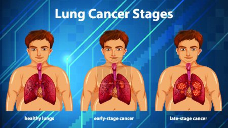 Illustration for Informative illustration of lung cancer stages - Royalty Free Image