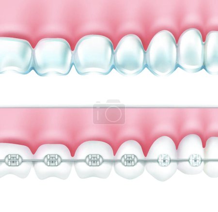 Illustration for Human teeth with braces set - Royalty Free Image