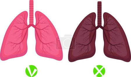 Illustration for "Healthy lungs and lungs disease or smoker infographics Isolated on white background. Vector illustration" - Royalty Free Image