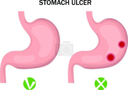 Téléchargez les illustrations : "Ulcère d'estomac et infographie de l'estomac sain. Concept de médecine. Illustration vectorielle" - en licence libre de droit
