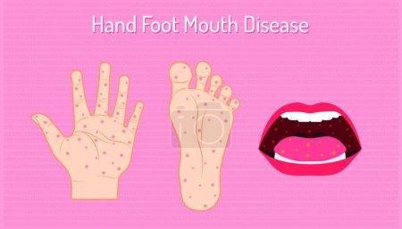 Illustration for Hand foot mouth disease. enteroviruses or EV71 is name of virus. be careful of your chidren and yourself. beautiful color background. vector illustration eps10 - Royalty Free Image