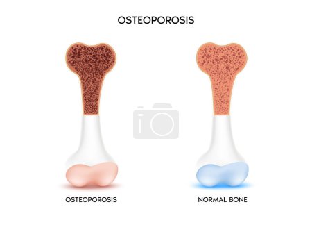 Healthy bone and unhealthy bone, Osteoporosis. Medical or healthcare concept. bone protection. Isolated on a white background. Realistic 3d Vector illustration 