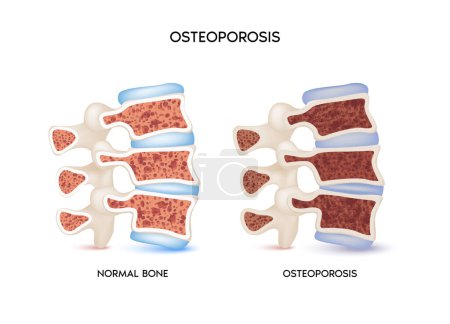 Huesos espinales, Hueso sano e insalubre, Osteoporosis. Concepto médico o sanitario. protección ósea. Aislado sobre un fondo blanco. Ilustración realista del vector 3d 