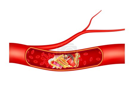 El vaso sanguíneo está bloqueado con comida rápida, hamburguesa. Enfermedad microvascular trombosis arterial del colesterol. En los vasos sanguíneos humanos. Ilustración vectorial 3D.