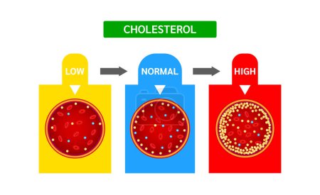 Illustration for Cholesterol meter or scale comparison with HDL High density lipoprotein and LDL Low density lipoprotein. Normal blood flow and Cholesterol artery thrombosis disease. Medicine and health Vector. - Royalty Free Image