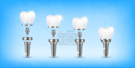 Illustration for Tooth and teeth implant for stomatology set. Implant structure models. Screw denture orthodontic implantation. stomatology clinic concept. Realistic isolated 3D vector illustration. - Royalty Free Image