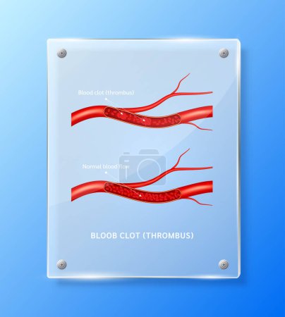 Illustration for Blood clot (thrombus) in human blood vessels inside square translucent glass panels for pharmacy advertisement. Poster banner design for clinics, hospital. Medic science concept. Realistic 3D Vector. - Royalty Free Image