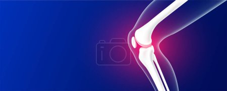 Illustration for Leg bones and knee joint cartilage inflammation on blue background with copy space for text. Human skeleton anatomy. Medical health care science concept. Realistic 3D vector. - Royalty Free Image