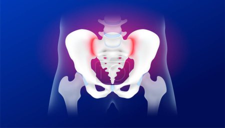 Human pelvis or hip bone anatomy isolated on blue background. Pelvic and hip joint pain. Arthritis cartilage becomes worn this results in inflammation swelling. Medical x ray film concept. 3d vector.