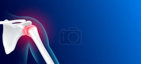 Illustration for Shoulder bone pain and joint arthritis cartilage becomes worn this results in inflammation swelling. Human skeleton anatomy with copy space for text. Medical x ray film concept. Realistic 3D vector. - Royalty Free Image