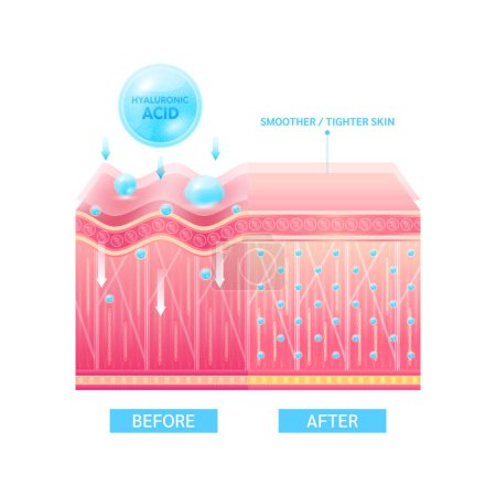 Illustration for Hyaluronic acid serum drop blue absorbed into the skin cell. Before and after process of getting skin younger with help of moisturizer collagen. Solution for cosmetic advertising. 3D Vector EPS10. - Royalty Free Image