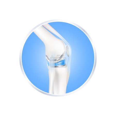 Illustration for Label aluminum. Knee replacement surgery total implant for treatment relieve arthritis, after joint damaged. Leg bone and side. Isolated on white background for product design. Realistic 3d vector. - Royalty Free Image