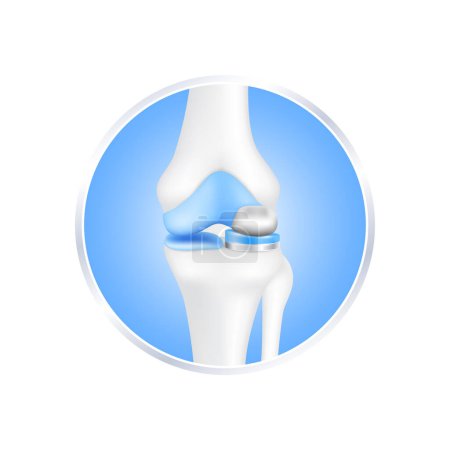 Etikett Aluminium. Knieersatzoperationen partielles Implantat zur Behandlung lindern Arthritis, nachdem das Gelenk beschädigt wurde. Beinknochenknorpel. Isoliert auf weißem Hintergrund für Produktdesign. Realistischer 3D-Vektor.