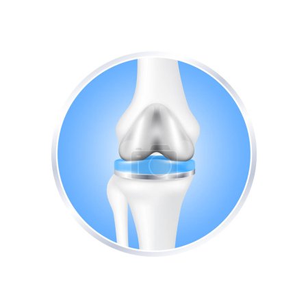 Etikett Aluminium. Knieersatzoperationen Totalimplantat zur Behandlung lindern Arthritis, nachdem das Gelenk beschädigt wurde. Beinknochenknorpel. Isoliert auf weißem Hintergrund für Produktdesign. Realistischer 3D-Vektor.