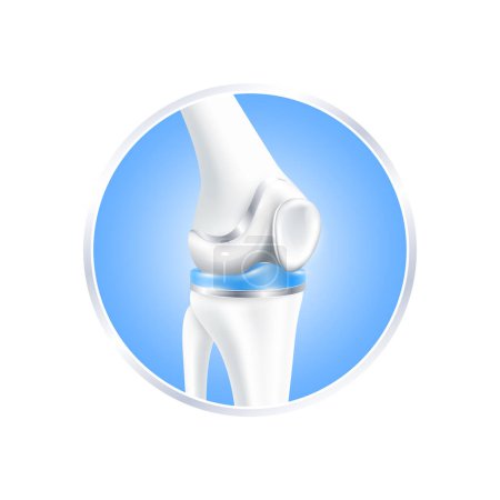 etiqueta aluminio. Cirugía de reemplazo de rodilla implante total para el tratamiento aliviar la artritis, después de la articulación dañada. Pierna de hueso de 45 grados de ángulo. Para el diseño del producto. Vector 3D realista aislado.