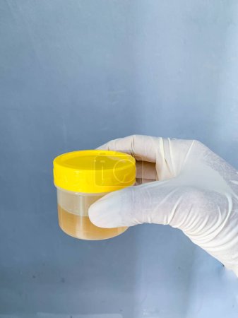 Téléchargez les photos : Un échantillon d'urine est tenu dans la main d'un homme portant des gants médicaux blancs - en image libre de droit