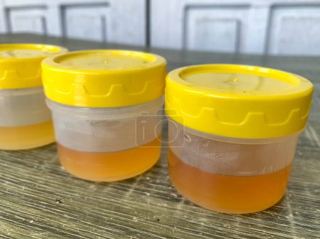 Téléchargez les photos : Un prélèvement d'échantillons d'urine jaunes sur la table pour examen en laboratoire - en image libre de droit