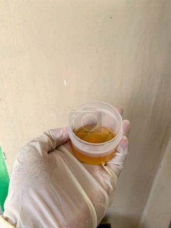 Téléchargez les photos : Un échantillon d'urine est tenu dans la main d'un homme portant des gants médicaux blancs - en image libre de droit