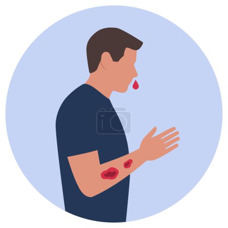 Ilustración de Icono de fácil sangrado, moretones y lesiones: hombre con hemorragia nasal y moretones en el brazo - Imagen libre de derechos