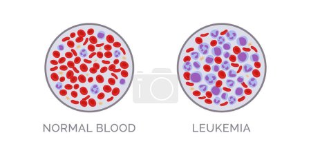 Illustration for Blood test comparison: normal and leukemia, blood cancer diagnosis concept - Royalty Free Image