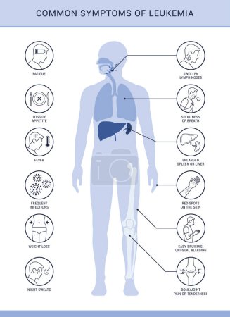 Ilustración de Síntomas y signos comunes de leucemia, infografía con iconos - Imagen libre de derechos