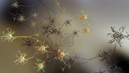 Foto de Lesión cerebral traumática leve, neuronas dañadas, enfermedad de los alzheimers, lesión axonal difusa, interrupción en la comunicación nerviosa, renderización 3d - Imagen libre de derechos