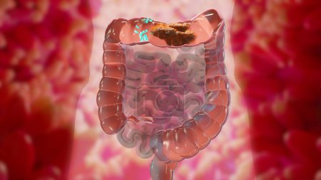 3D-Illustration der Anatomie des menschlichen Verdauungssystems, Konzept des Darms, Abführmittel, Verrat an Verstopfung, 3D-Darstellung