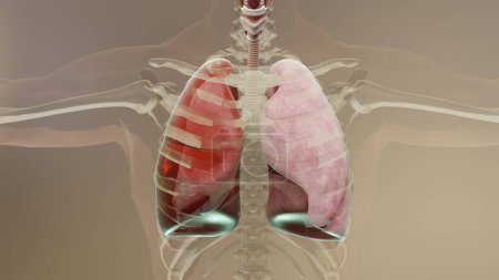 Photo for 3d Illustration of Hemothorax, Normal lung versus collapsed, symptoms of Hemothorax, pleural effusion, empyema, complications after a chest injury, air in the pleural space, 3d Render - Royalty Free Image