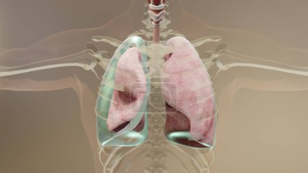 3d Illustration des Pneumothorax, Normale Lunge versus Kollaps, Symptome des Pneumothorax, Pleuraerguss, Empyema, Komplikationen nach einer Brustverletzung, Luft im Pleuraraum, 3d Render