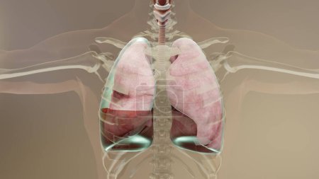 3D Illustration des Hämopneumothorax, normale Lunge versus Kollaps, Symptome des Hämopneumothorax, Pleuraerguss, Empyema, Komplikationen nach einer Brustverletzung, Luft im Pleuraraum, 3D Render