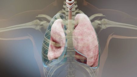 Photo for 3d Illustration of Pneumothorax, Normal lung versus collapsed, symptoms of pneumothorax, pleural effusion, empyema, complications after a chest injury, air in the pleural space, 3d Render - Royalty Free Image