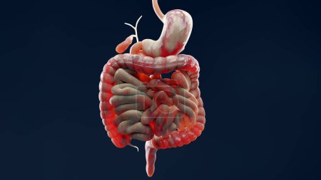 Photo for Man suffering from crohns disease, male anatomy, inflamed large intestine, Sigmoid Colon, human digestive system parts, 3d render - Royalty Free Image